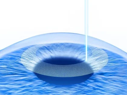 عملية تصحيح النظر