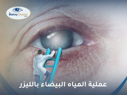 عملية المياه البيضاء بالليزر