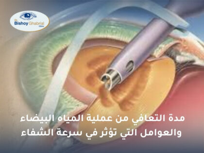 مدة التعافي من عملية المياه البيضاء