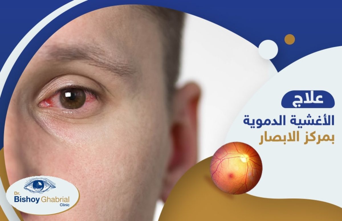 الاغشية-الدموية-بمركز-الابصار