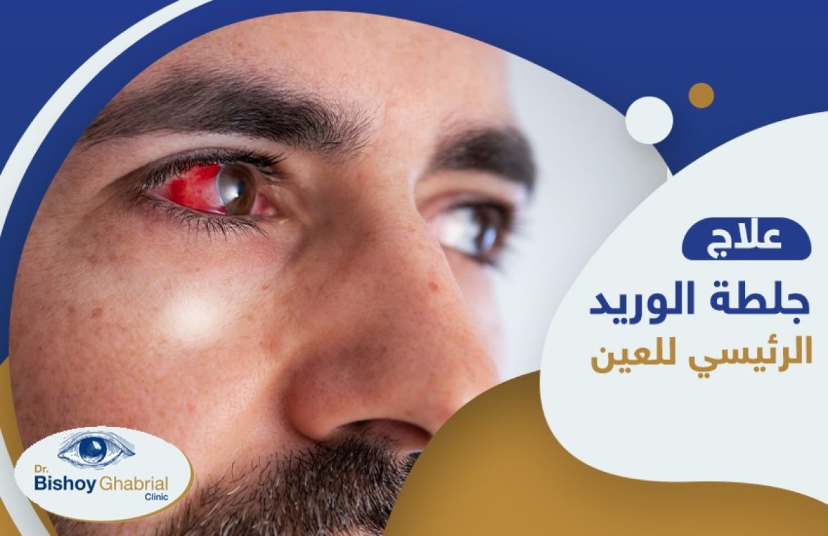 جلطة-الوريد-الرئيسي-للعين-وعلاجه