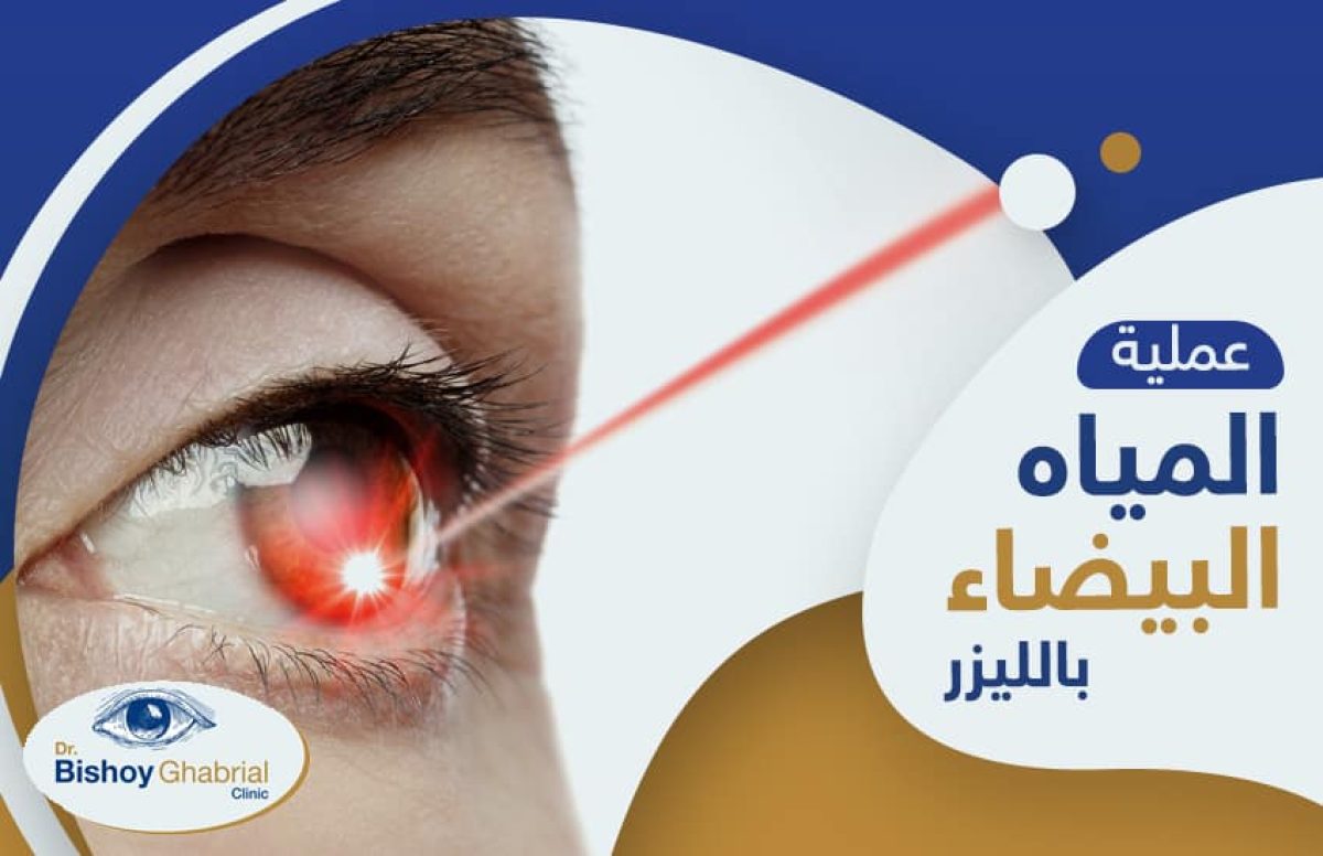 عملية-المياه-البيضاء-بالليزر